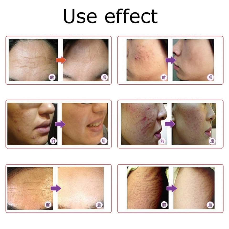 ULTIMA M7 Dr Pen - Derma Pen Micro Needling System Adjustable - Derma Pen For PRP - Micro needling Pen Devices in Pakistan
