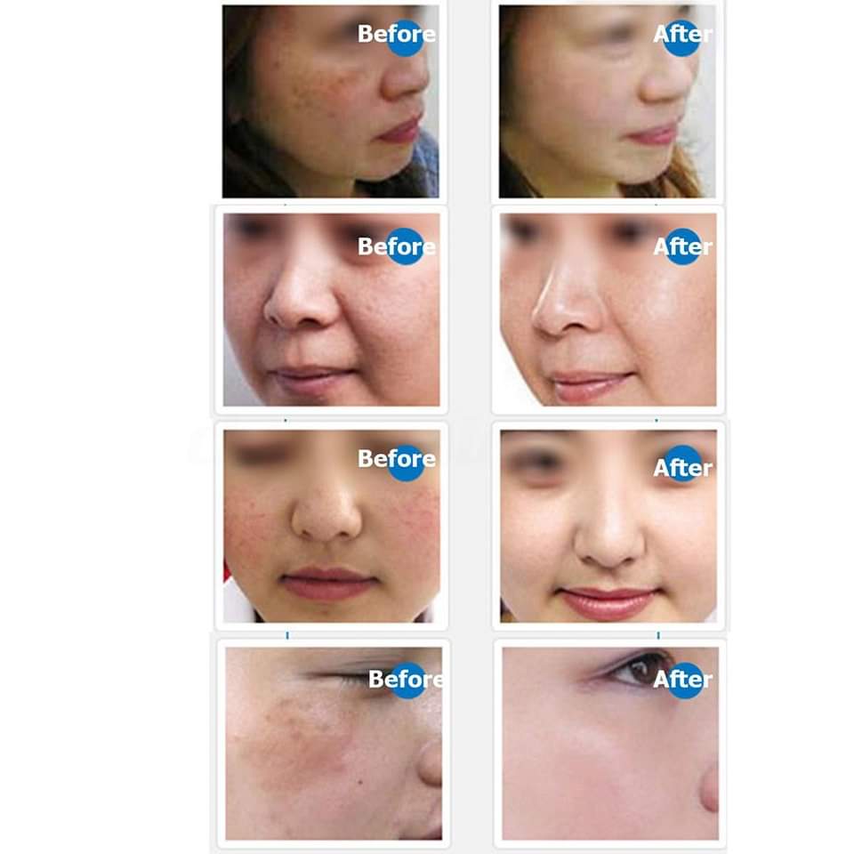 ULTIMA M7 Dr Pen - Derma Pen Micro Needling System Adjustable - Derma Pen For PRP - Micro needling Pen Devices in Pakistan