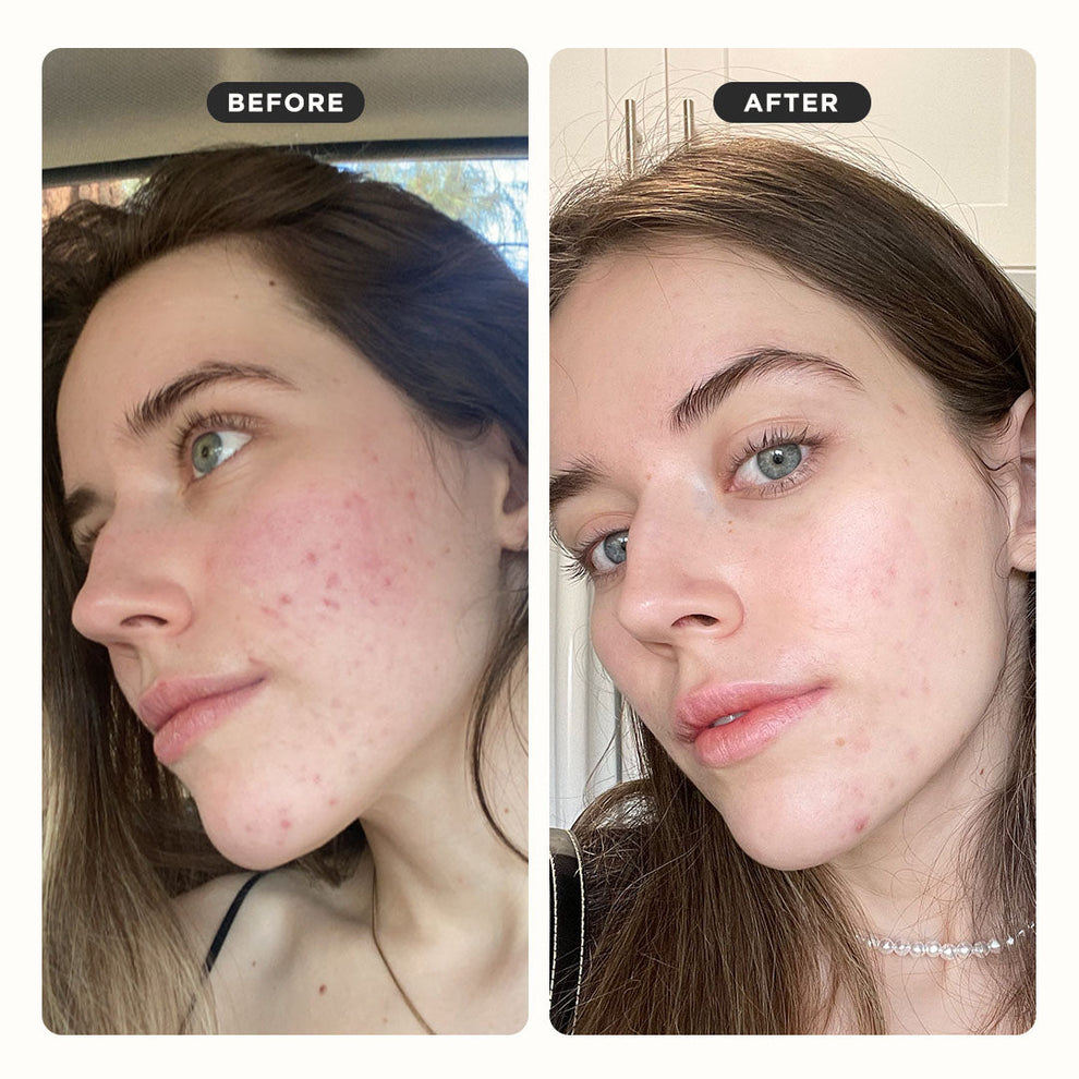 PRESS REFRESH HYDROGEL EXFOLIATING SHEET MASK 

Description
PRESS REFRESH is *not your average sheet mask* This jelly-like cutie is drenched in exfoliating acids and skin soothers to calm redness and irritation, unclog pores, refine uneven texture and bea